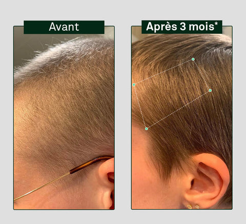 Before and after comparison of hair growth on a person's head, showing visible difference after three months.