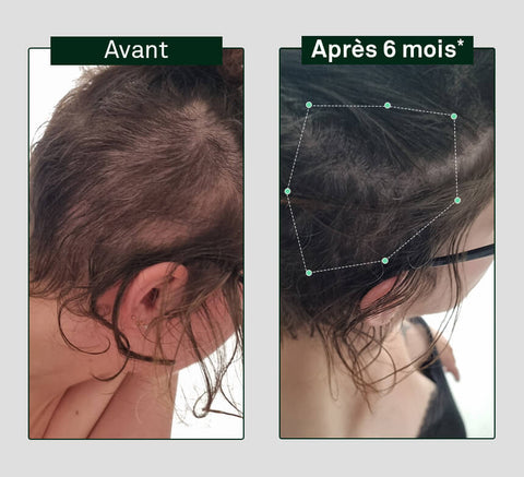 Before and after comparison of hair growth on a person's head, showing visible difference after six months.