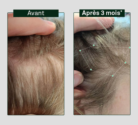 Before and after 3 months hair density protocole