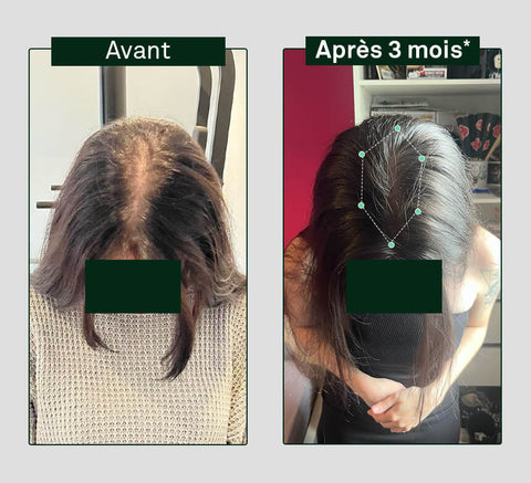 Before and after comparison of hair growth on a person's head, showing visible difference after 3 months.