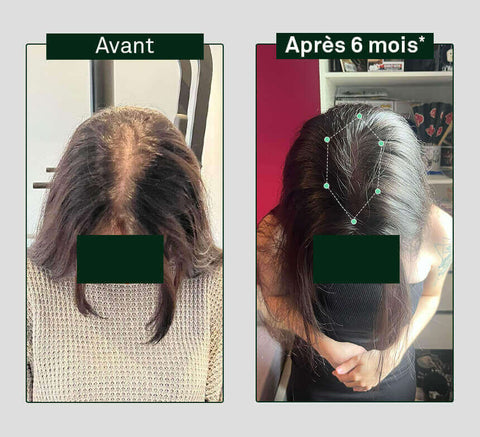 Before and after 3 months – crown view showing increased hair density.