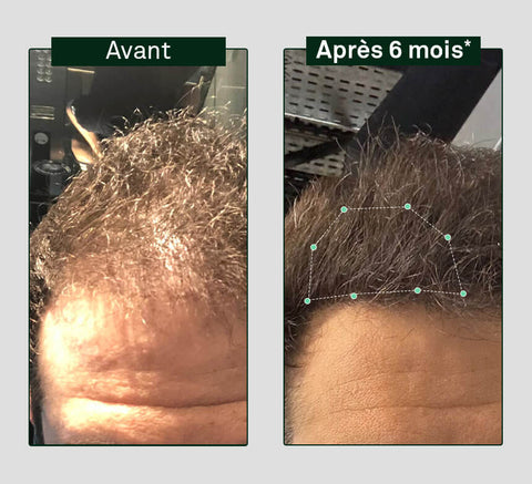 Before and after comparison of hair growth on a person's head, showing visible difference after six months.